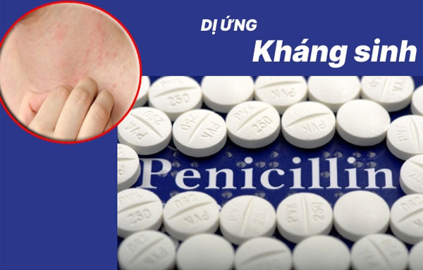 Penicillin là thuốc kháng sinh thường gây dị ứng nhiều nhất 
